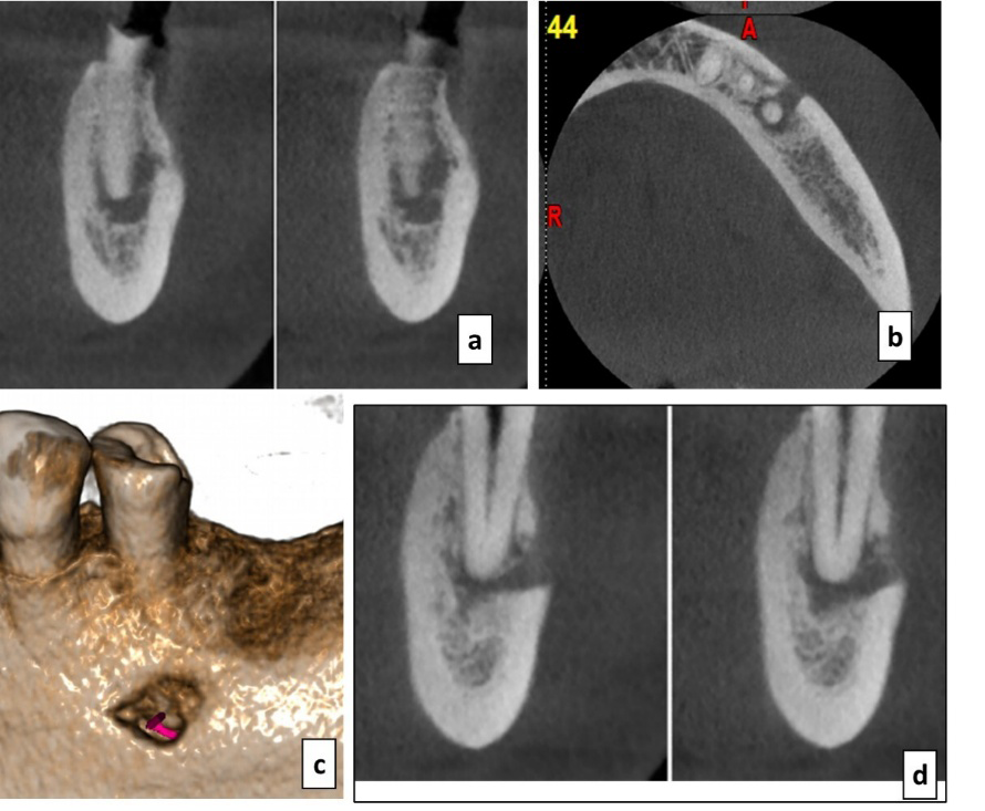 Figure 2: 3-D Imaging evaluation using CBCT. a. Transaxial section of #20 showing periapical lesion involving inferior alveolar canal with erosion on upper cortex of IAN canal. b. Axial section displaying periapical lesion involving mental foramen. c. 3D representation of the spatial relationship of mental nerve foramen with periapical lesion of #20 d. Transaxial section showing an ill-defined periapical radiolucency involving mental foramen with erosion of buccal cortical plate.