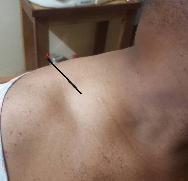 Figure 2: Figure showing accumalation of supraclavicular fat pads (A), consistent with Cushing’s syndrome.