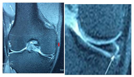 Figure 3: Medial meniscus injury on MRI in a 29-year-old physical education and sports teacher after a soccer sport accident (CHOM photo)