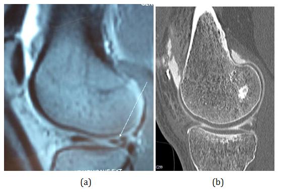 Figure 6: Initial (a) and arthroscannographic MRI images of a 32-year-old patient at A + 3 (b) showing partial scarring