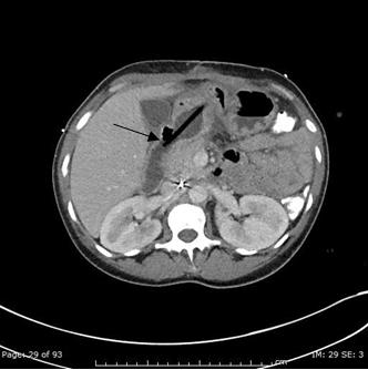 Figure 2: Axial abdominopelvic CT image (3/7/2017) shows distal migration of the gastrostomy tube into the proximal duodenum.