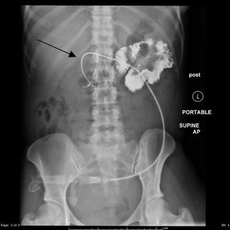 Figure 3: Fluoroscopic image (3/7/2017) demonstrates a percutaneous enterostomy tube, with contrast seen in proximal small bowel loops. No definite contrast is seen in the gastric lumen.