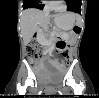 Figure 4: Coronal abdominopelvic CT image (3/27/2017) demonstrates further distal migration of the gastrostomy tube balloon within the proximal jejunum with small bowel obstruction more proximally. Incidentally, an enlarged myomatous uterus is seen.