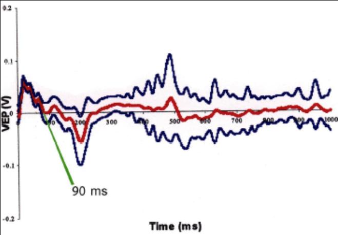 Figure 12: Flash VEP on Optic Nerve Compression Injury group treated with Stem cells. Latency time=90msec.