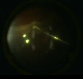 Figure 1: Making the reattachment experiment. Touching the retina with the cutter under air: is evident that some stiffness and traction is remaining.
