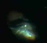 Figure 2: Interface vitrectomy: the retinectomy´s edges are remodeled and shaved using the cutter through the aqueous interface confined between the air and PFO.