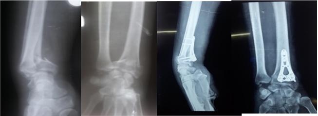 Figure 1: Preoperative and final follow up radiographs of a 34 years old male with type C2 fracture of the distal radius.