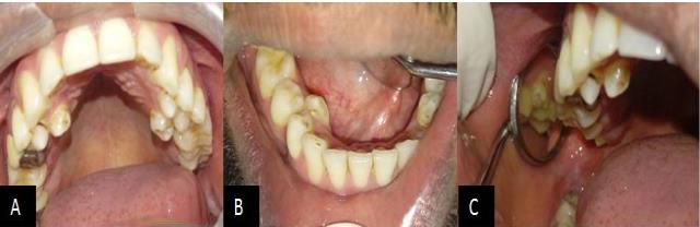 Figure 3: Showing OPG with multiple impacted supernumerary teeth.