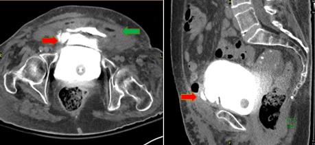 Figure 1: CT Cystogram Axial and Lateral view showing the bladder extravasation (red arrow) and surrounding soft tissue edema (green arrow).