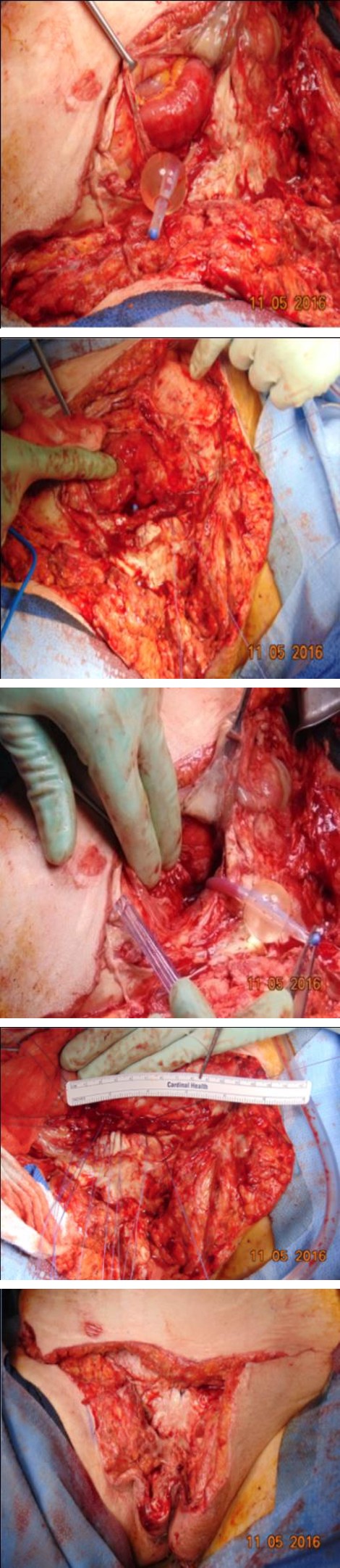 Figure 2: Operative picture Day 3 after debridement showing necrosis of the fascia (arrow)