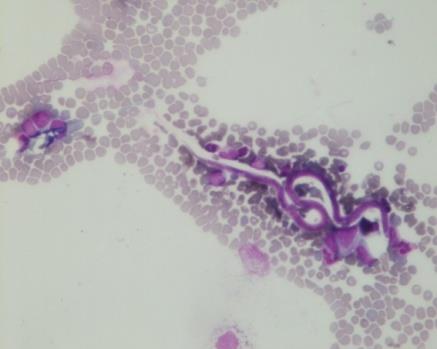 Figure 1: Microfilaria with few blast- 40x