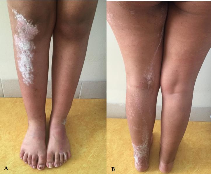 Figure 3: Erythematous and scaly plaques with linear disposition localised to the right leg, a) Anterior face, b) Posterior face.