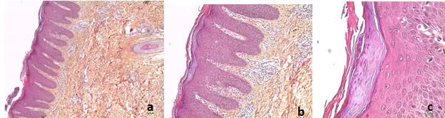 Figure 5: a) Coloration HES G x 50Regular psoriasiform hyperplasia, b) Coloration HES G x 200 Parakeratosis with tortulous vessels of the papillary dermis, c) Coloration HES G x 400Microabcies in parakeratosis.