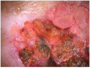 Figure 2: Ulcerous-budding Tumor of 4 cm, covered with hemorrhagic and mellicheric crusts, localised to the right hand.