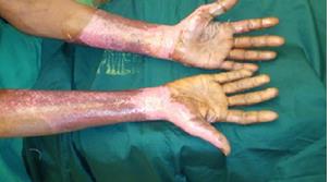 Figure 4: After 6 months of LLLT.