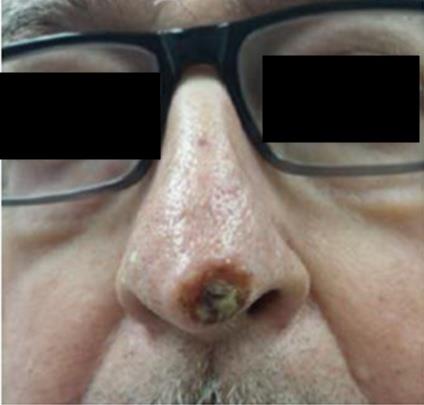 Figure 1: 1.5 cm x 1.6 cm squamous cell carcinoma (SCC) on the nasal tip. Image from Mohs Dermatologist.