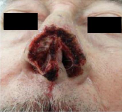 Figure 2: Final defect after Mohs surgery of 3.2 cm x 3.1 cm with depth including cartilage and nasal mucosa. Image from Mohs dermatologist. Preoperative assessment by cardiothoracic anesthesia and his cardiologist was completed. Anticoagulation of elliquis and aspirin was stopped a week prior to surgery. He continued the remainder of his home medications including immunosuppression of tacrolimus 2 mg PO BID, sirolimus 1 mg PO qhs, and prednisone 10 mg daily, and PCP prophylaxis with bactrim weekly and azithromycin for treatment of chronic allograft dysfunction. He was deemed optimized for surgery. The operation consisted of surgical preparation with re-excision of eschar and necrotic skin, subcutaneous tissue, muscle and fascia and cartilage, throughout the entire 5 x 5 cm wound, right paramedian forehead flap to nose, right intranasal axial fasciocutaneous septal lining flap, based on the right septal artery, left intranasal axial fasciocutaneous septal lining flap, based on left septal artery, right ear cartilage graft to nose, septal cartilage and bone graft to nose, xenograft placement, 4 x 6 cm epidermal coverage to back of paramedian forehead flap stalk, and xenograft bolster to right ear (Figure 3). Total operative time was 4 hr and 47 min. It was completed successfully with general anesthesia of propofol and remifentanil, without complication. Oral packing removed and oral gastric tube was passed with stomach suctioned of blood. The patient was extubated and following commands with adequate tidal volume in the operating room.