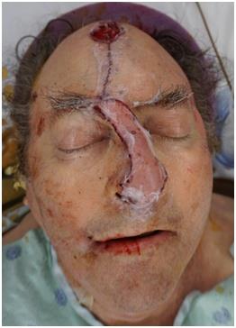 Figure 3: Immediately Post-operative from surgical preparation with re-excision of eschar and necrotic skin, subcutaneous tissue, muscle and fascia and cartilage, throughout the entire 5 x 5 cm wound, right paramedian forehead flap to nose, right intranasal axial fasciocutaneous septal lining flap, based on the right septal artery, left intranasal axial fasciocutaneous septal lining flap, based on left septal artery, right ear cartilage graft to nose, septal cartilage and bone graft to nose, xenograft placement, 4 x 6 cm to back of paramedian forehead flap stalk, and xenograft bolster to right ear. Immediately postoperatively in the recovery unit, the patient had persistent bleeding from the nose and difficulty clearing secretions. Suctioning and duoneb administered with minimal improvement in spO2 77- 82%, with patient becoming increasingly tachypneic and increased work of breathing. Noninvasive ventilation would have compromised the flap so re-intubation was performed. Bronchoscopy was performed with several clots removed. SpO2 immediately improved to 100%. Decision was made to continue intubation for 3 days to protect airway from continued surgical site bleeding. OG tube was placed to prevent aspiration. Post operatively, he received his home medications except Elliquis, ASA, and Sirolimus. For perioperative prophylaxis, he was given unasyn IV, and mupirocin ointment to suture lines. 1 unit of packed red blood cells was given for an acute decrease in hemoglobin from 8.5 to 7.7 on postoperative day 2 (POD2), afterwhich he remained at a baseline hemoglobin of approximately 9 for the duration of his hospitalization. He was extubated POD3 without complication. A few days post extubation, he developed ICU delirium which quickly resolved. SQH was started POD7. Elliquis and ASA were restarted POD8. He was ready for discharge POD7 but remained inpatient until POD14 due to Hurricane Harvey preventing travel in the area to his home that is 6 hours away. On discharge, the paramedian forehead flap and septal lining flaps were clean, dry, and intact, and well perfused without concern for ischemia or congestion. One month postoperatively, he was seen in plastic surgery clinic. At that time the left intranasal flap was torn and partially necrotic. He had been itching his left nostril with his finger. Decision was made to return to the operating room for debridement the next day with post op admission for airway monitoring. Debridement of necrotic mucosa of nasal lining flaps and underlying exposed cartilage and with readvancement was done. There were no complications and he was discharged POD1. Second stage paramedian forehead flap inset was planned for the next month. Patient was taken back 2 months after the initial surgery for final division and inset of paramedian forehead flap at nose, and forehead adjacent tissue transfer flaps, less than 10 sq cm. Patient was discharged the same day with no complication and appropriate nasal tip contour. He resumed sirolimus around 6 weeks after surgery. Recent postoperative photos show appropriate coverage (Figure 4).