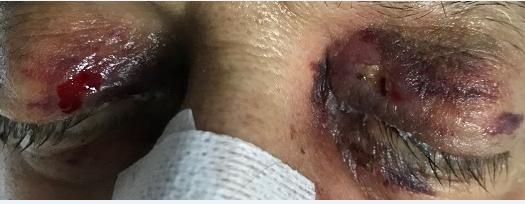 Figure 2: Healing of the wound with crusts is seen 7th day after having removed the adhesive tape.