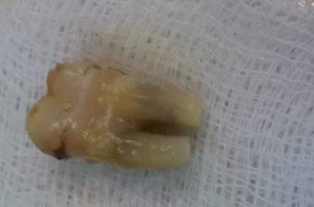 Figure 4: Root planning, conditioning & Apicectomy.