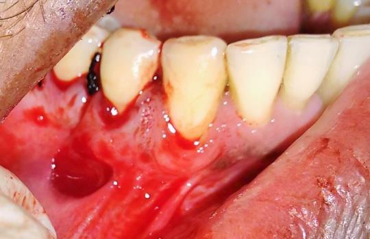 Figure 2: Intraoperative view during buccal frenotomy.