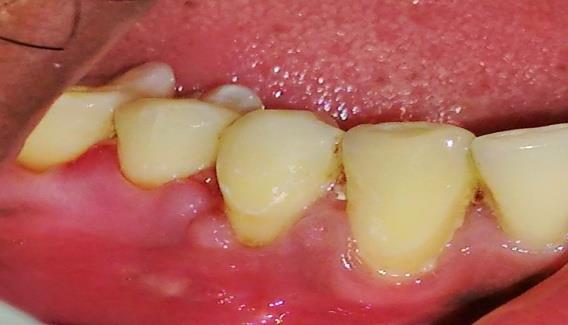 Figure 4: Postoperative view after follow up of 1 month.