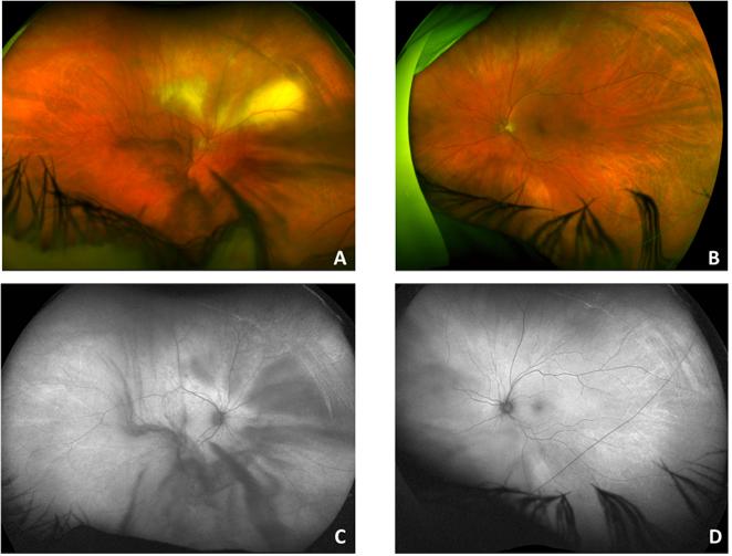 Figure 1: Retinal imaging at initial presentation. Figure 1A: Color fundus photograph of the right eye showing areas of yellow sub retinal infiltrates above the optic disc and superior arcade with small areas of intra retinal hemorrhages and vitreous opacities. Figure 1C: Auto fluorescence image of the right eye showing mixed hyper- and hypo-auto fluorescence superiorly and temporally corresponding with the infiltrates. Figure 1B + 1D: Color fundus photograph and auto fluorescence image of the left eye appears unremarkable. At this time, the patient underwent aspiration of vitreous fluid as well as an intravitreal injection of clindamycin, due to concern for toxoplasmosis. She was started on oral treatment for toxoplasmosis with oral trimethoprim/sulfamethoxazole and clindamycin. The vitreous fluid was sent for HSV, VZV, and toxoplasmosis testing, which were negative. A repeat aspiration of vitreous fluid was sent for cytopathologicalexamination and was found to be suspicious for lymphoma. At this time, a diagnostic pars plana vitrectomy was scheduled. Microscopic analysis of the vitrectomy sample showed large, highly atypical lymphoid cells displaying irregular nuclear membrane contours and multiple prominent nucleoli (Figure 2).