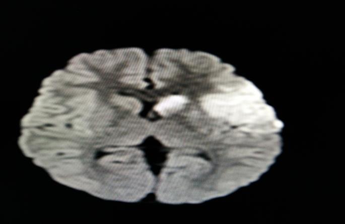 Figure 1: MRI of brain showing left middle cerebral artery territory infarcts.