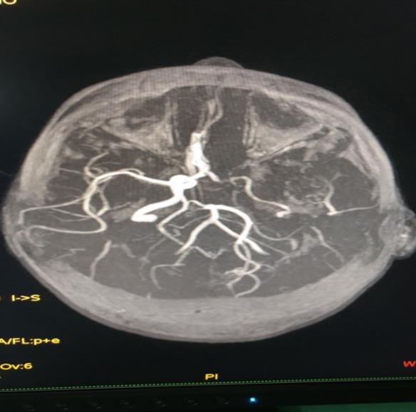 Figure 2: MRA of the brain showing atherosclerotic narrowing of left middle cerebral artery segment.