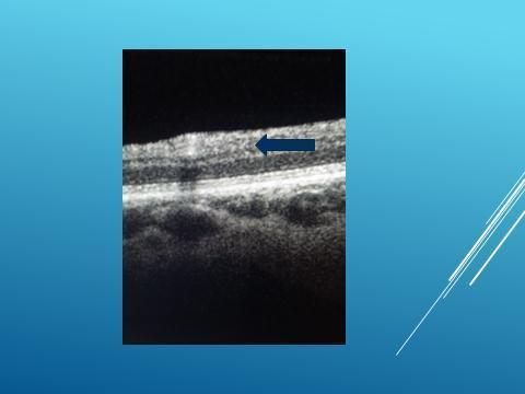 Figure 3: SD- OCT image of PHFs.
