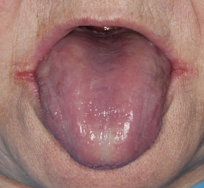 Figure 1: Severe xerostomia, atrophic tongue, perlèche (©School of Dentistry, Vienna).