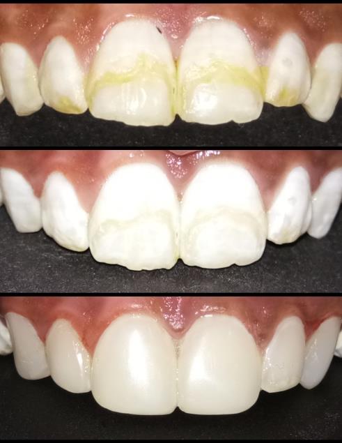 Figure 1: A. Pre-operative photograph, B. After Bleaching, C. Post-operative Photograph.