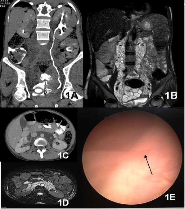 Figure 1: 1A, 1C: CT scan (coronal and transverse view) showing left normal ureter and retroperitoneal mass encasing both ureters. 1B, 1D: MRI (Coronal and transverse view) showing extension of retroperitoneal mass. 1E: Cystoscopy showing chylous efflux coming from left ureter.