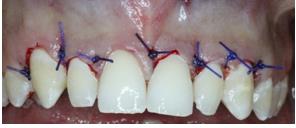 Figure 1: Preoperative view: final step of the orthodontic treatment.