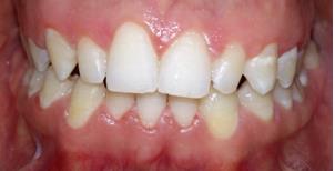 Figure 2: The gingivectomy from tooth #13 to tooth #23. Two months later, periodontal healing was thoroughly achieved, gingival margins were stabilized and gum exposure during smile improved (Figure 3).