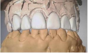 Figure 4: Extremely conservative tooth preparation within enamel from tooth #13 to tooth #23.