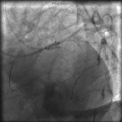 Figure 3: Simultaneous inflation of 3 kissing balloons. As a result of PCI to ramus branch, the ostium of LAD and LCX were comprised, so we did kissing balloons for both LAD and Ramus. The result was good but the ostium of LCX was affected. Then we did kissing balloons between ramus and LCX. The result was good for LCX and ramus but the LAD was compromised again, so we did the kissing balloons at the same time for LAD, ramus and LCx. The final angiographic picture showed a successful revascularization with (TIMI) flow (Figure 4). The patient was asymptomatic and discharged the next day and was advised to continue DAPT with statin.