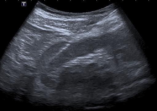 Figure 1: a) Longitudinal section of ultrasound showing localized renal biopsy of a mass in the upper pole of the left kidney in a male patient of 72 years, which resulted in a plasmacytoma. b) Longitudinal section of ultrasound showing non-localized renal biopsy in a 29-year-old patient with a history of Lupus and proteinuria.
