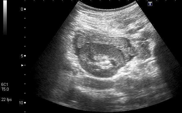 Figure 2: Axial ultrasound section showing perirenal hematoma as a biopsy complication in a 16-year-old female patient with lupus nephropathy. Percutaneous nephrostomy is the placement of external drainage in the renal collecting system. Its main indication is the presence of urinary leaks, decompression of renal or perirenal collections or to facilitate percutaneous access for other urological procedures (stent placement, nephrolithotomy, extraction of foreign bodies, administration of medication). The only contraindication, which is relative, is coagulopathy. As for the renal biopsy, the position of the patient must be prone (native kidney) or supine (transplanted kidney), and the approach must be made by Brodel's avascular plane, which is about