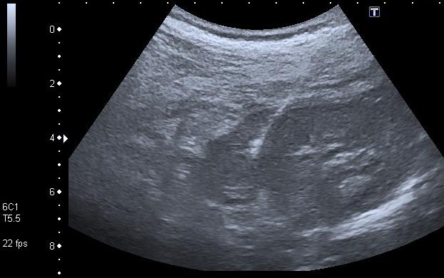 Figure 3: Control pyelography after placement of left nephrostomy, where adequate position and functioning are confirmed. The placement of double J catheters follows the same steps for the placement of the nephrostomy but the guide and catheter are advanced to their final position: proximal within the renal pelvis and distally within the bladder (Figure 4). Indications include renal lithiasis, ureteral fistula, ureteral stenosis, urinoma or risk of displacement of a nephrostomy. The only contraindication, which is relative, is coagulopathy. Among the most frequent complications are clogging or embedding of the catheter, its distal migration or, less frequently, ureteral rupture [1,6].