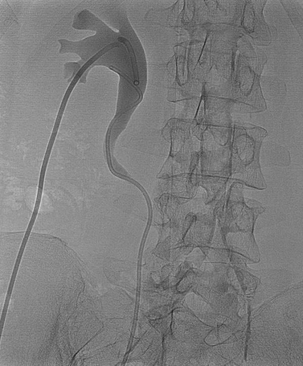 Figure 4: Placement of leftnephrostomyand ureteral stent. a) The same steps are carried out as for the placement of a nephrostomy and the catheter is advanced to its final position. b) Final position of the ureteral stent with proximal end in the renal pelvis and distal end in the bladder.