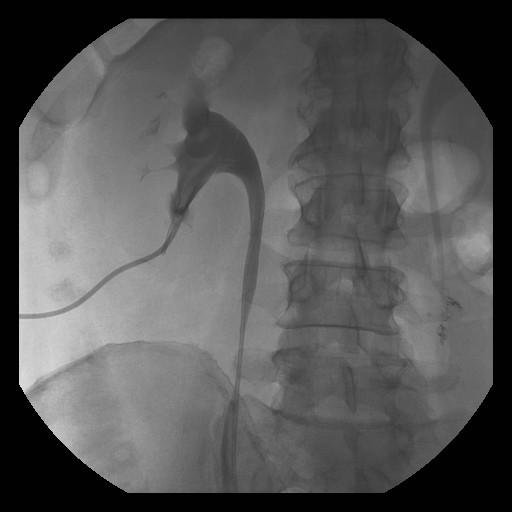 Figure 5: (a) Axial section of abdominal CT in which left renal angiomyolipoma is demonstrated. (b) Angiography image by selective digital subtraction of the left renal artery. The branches supplying the lesion are detected (c), and embolization is performed with PVA microparticles (d), with subsequent evidence of an adequate supraselective embolization of the lesion. Tumor ablation consists in the direct local percutaneous destruction of the malignant tissue through the application of energy (radiofrequency, freezing, microwaves) or chemical substances. The most commonly used modalities are radiofrequency ablation where heat is used and microwave ablation where cytotoxicity is also produced by heat. It is used as alternative management to surgery in patients with renal cell carcinoma (ideally lesions <4 cm) who are not surgical candidates for other comorbidities or in whom it is desired to preserve functioning renal parenchyma due to other causes such as a single kidney, kidney failure, von Hipple-Lindau syndrome, among others. It also represents a management option in patients with renal angiomyolipomas greater than 4 cm or with aneurysms greater than 5 mm. The procedure is contraindicated in patients with non-correctable coagulopathy and when the lesions to be treated are greater than 4 cm or are very close to vascular structures or to the collecting system, due to the risk of associated injury.