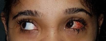 Figure 4: A patient with congenital superior oblique palsy showing head tilt to left side with midfacial hypoplasia, right eye hypertropia with right eye inferior oblique overaction.