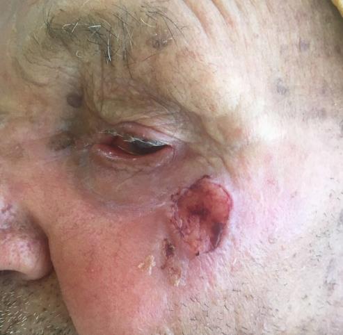 Figure 1: Erythematous, well-defined tumor of about 2.5 cm, of firm consistency, on the left malar region surrounded by multiple actinic keratoses on the face.