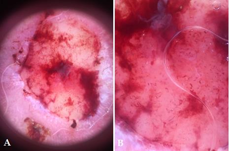 Figure 2: Polarized, contact dermoscopy showing a yellowish structure with polymorphic vascularization at the periphery and hemorrhagic suffusions. (A): low magnification, (B): high magnification.
