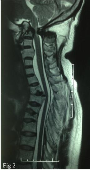 Figure 2: MRI: nonunion of the odontoid process, basilar impression , stenosis of the foramen magnum , medullary suffering and partial destruction of vertebral body of D3.