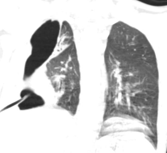 Figure 1: CT scan, direct projection. The presence of fluid and free gas in the pleural cavity, a shift of the mediastinum to the healthy side is noted.