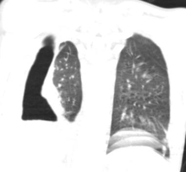 Figure 2: CT scan, the air is not connected with the lungs, the presence of a fistula connected with the bronchial tree.