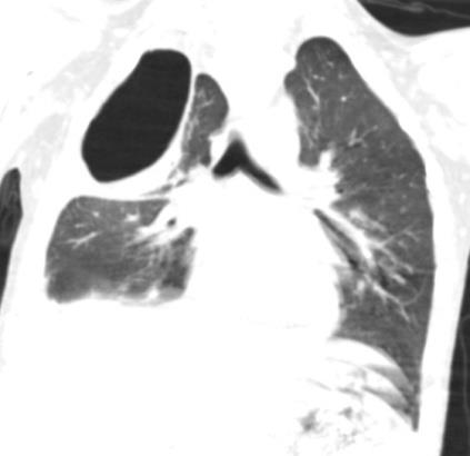 Figure 3: The lateral projection of CT scan. The relation of the fistula to the root of the lung. When all the diagnostic procedures were carried out, bronchoscopy, lavage of the bronchial tree, occlusions of the right upper lobe bronchus were performed. After that, the separation of air from the drainage pipe immediately stopped. The drainage tube functioned for 8 days. After 12 days, bronchoscopy, removal of the occludor, lavage of the bronchial tree was performed. On x-ray control (Figure 4) - complete expansion of the lungs, absence of bronchopleural fistula was noted.