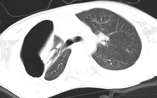 Figure 4: Chest X-ray in a direct projection. Complete expansion of the pleural cavity. Absence of fistula and free gas.